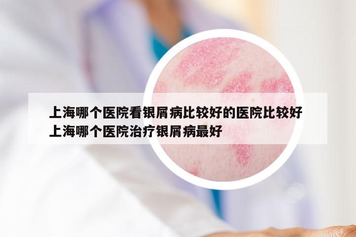 上海哪个医院看银屑病比较好的医院比较好 上海哪个医院治疗银屑病最好