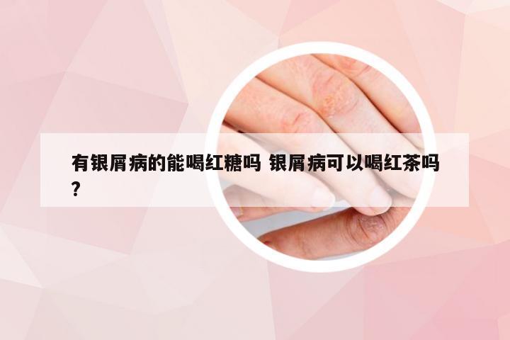有银屑病的能喝红糖吗 银屑病可以喝红茶吗?