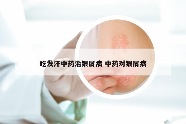 吃发汗中药治银屑病 中药对银屑病