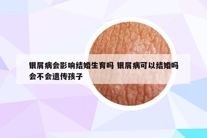 银屑病会影响结婚生育吗 银屑病可以结婚吗会不会遗传孩子