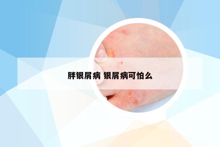 胖银屑病 银屑病可怕么