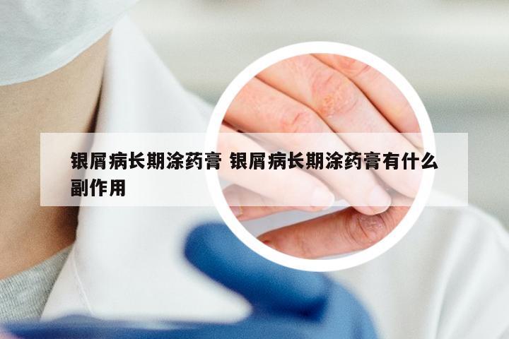 银屑病长期涂药膏 银屑病长期涂药膏有什么副作用