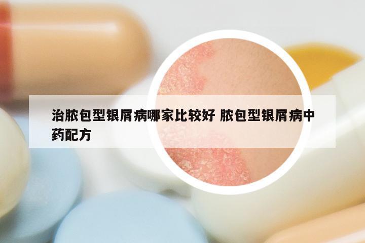 治脓包型银屑病哪家比较好 脓包型银屑病中药配方