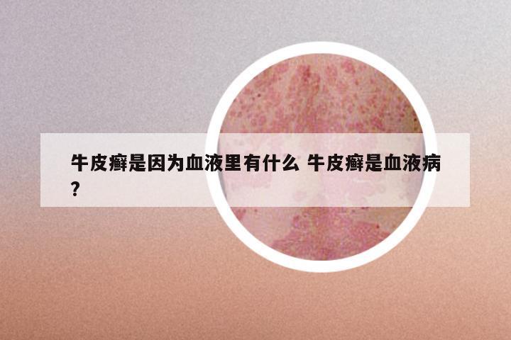 牛皮癣是因为血液里有什么 牛皮癣是血液病?