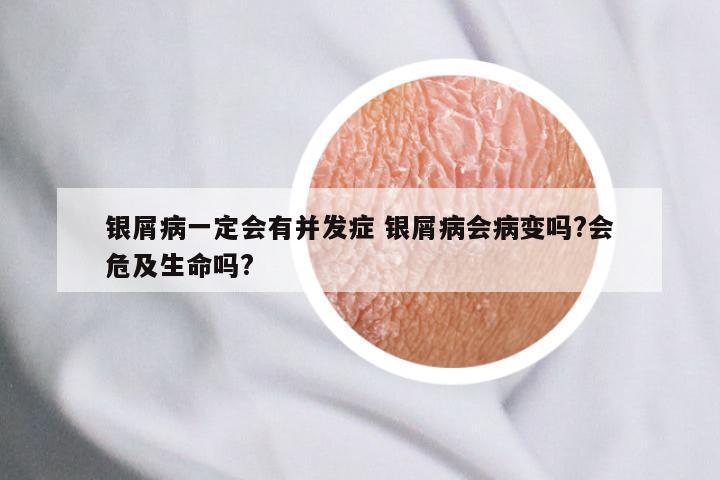 银屑病一定会有并发症 银屑病会病变吗?会危及生命吗?