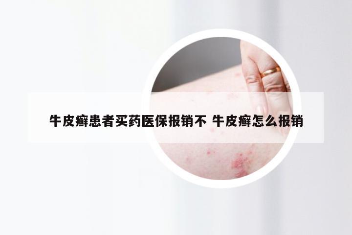 牛皮癣患者买药医保报销不 牛皮癣怎么报销
