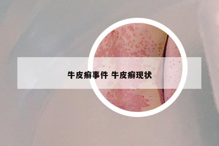 牛皮癣事件 牛皮癣现状