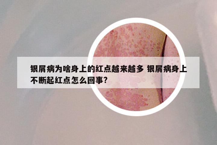 银屑病为啥身上的红点越来越多 银屑病身上不断起红点怎么回事?