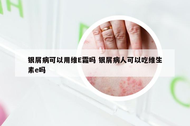 银屑病可以用维E霜吗 银屑病人可以吃维生素e吗