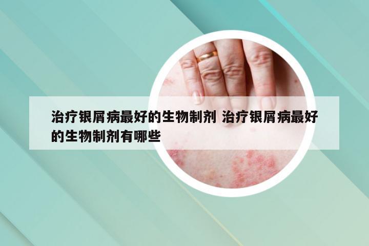 治疗银屑病最好的生物制剂 治疗银屑病最好的生物制剂有哪些