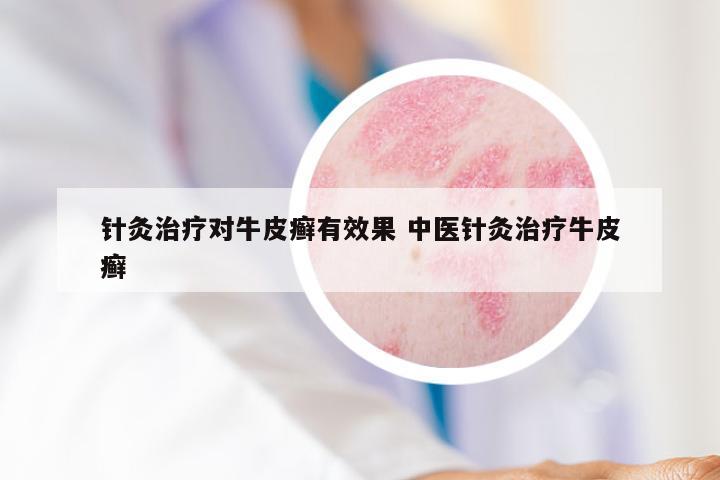 针灸治疗对牛皮癣有效果 中医针灸治疗牛皮癣
