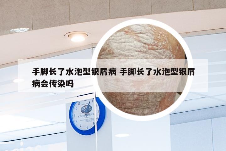 手脚长了水泡型银屑病 手脚长了水泡型银屑病会传染吗