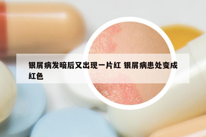 银屑病发暗后又出现一片红 银屑病患处变成红色