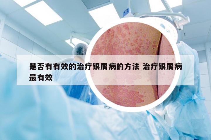 是否有有效的治疗银屑病的方法 治疗银屑病最有效