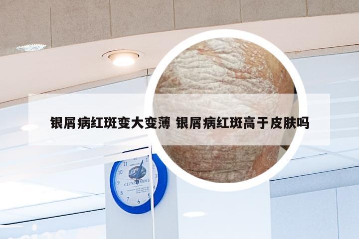 银屑病红斑变大变薄 银屑病红斑高于皮肤吗