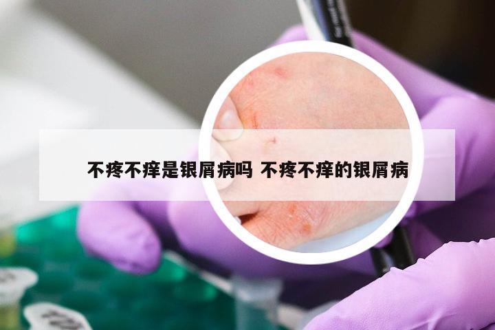 不疼不痒是银屑病吗 不疼不痒的银屑病