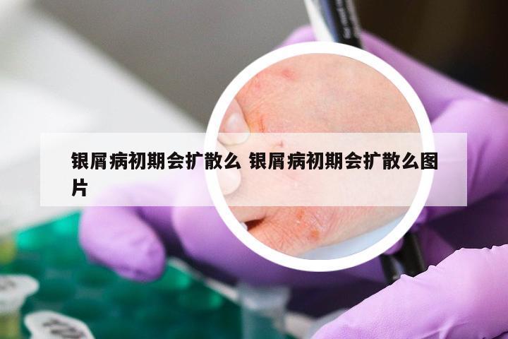银屑病初期会扩散么 银屑病初期会扩散么图片