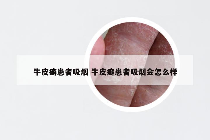 牛皮癣患者吸烟 牛皮癣患者吸烟会怎么样