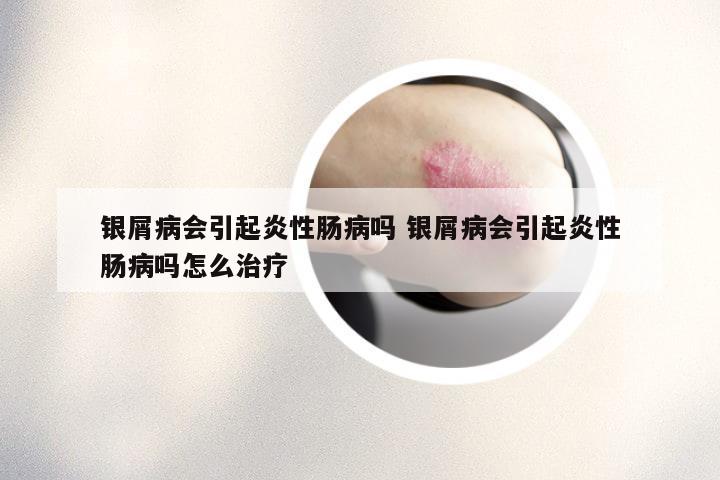 银屑病会引起炎性肠病吗 银屑病会引起炎性肠病吗怎么治疗