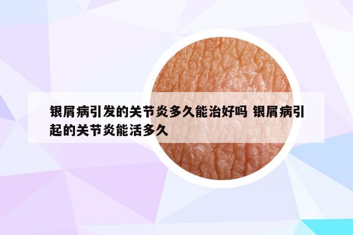 银屑病引发的关节炎多久能治好吗 银屑病引起的关节炎能活多久