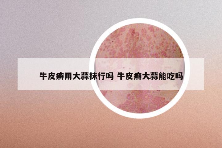 牛皮癣用大蒜抹行吗 牛皮癣大蒜能吃吗