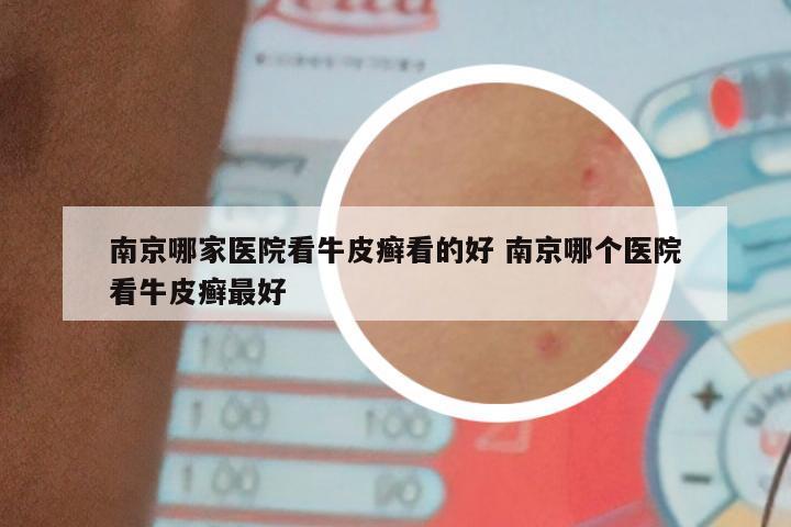 南京哪家医院看牛皮癣看的好 南京哪个医院看牛皮癣最好