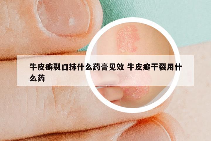 牛皮癣裂口抹什么药膏见效 牛皮癣干裂用什么药