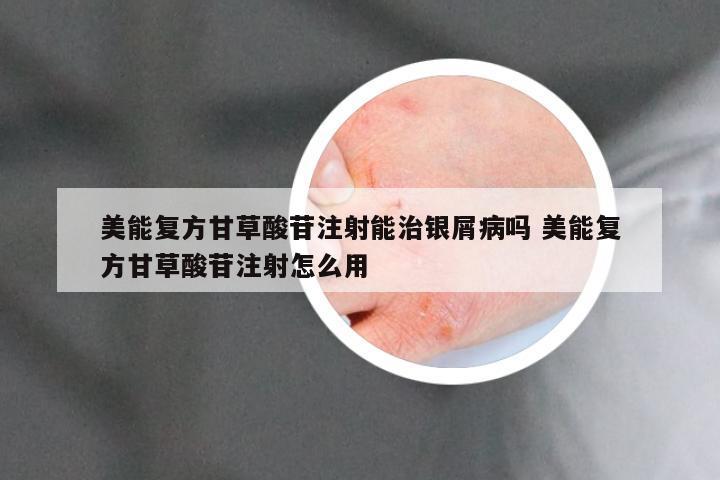 美能复方甘草酸苷注射能治银屑病吗 美能复方甘草酸苷注射怎么用