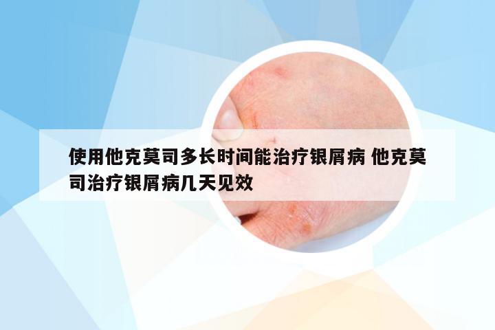 使用他克莫司多长时间能治疗银屑病 他克莫司治疗银屑病几天见效