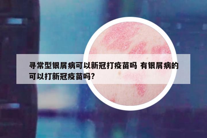 寻常型银屑病可以新冠打疫苗吗 有银屑病的可以打新冠疫苗吗?