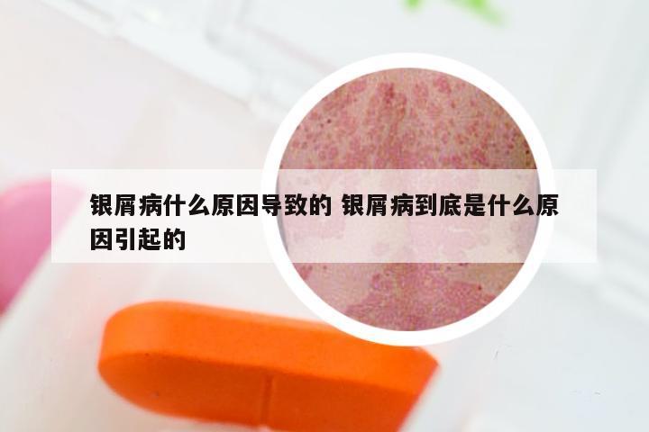 银屑病什么原因导致的 银屑病到底是什么原因引起的