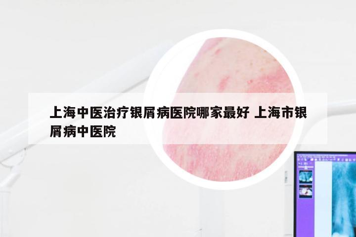 上海中医治疗银屑病医院哪家最好 上海市银屑病中医院