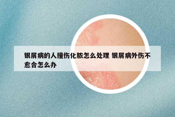 银屑病的人撞伤化脓怎么处理 银屑病外伤不愈合怎么办
