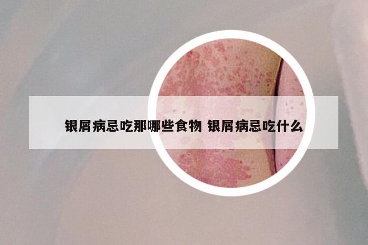 银屑病忌吃那哪些食物 银屑病忌吃什么