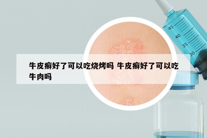 牛皮癣好了可以吃烧烤吗 牛皮癣好了可以吃牛肉吗