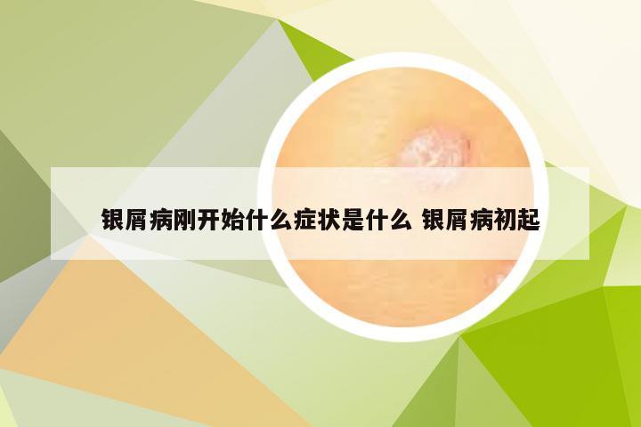 银屑病刚开始什么症状是什么 银屑病初起