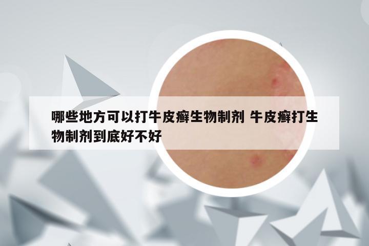 哪些地方可以打牛皮癣生物制剂 牛皮癣打生物制剂到底好不好