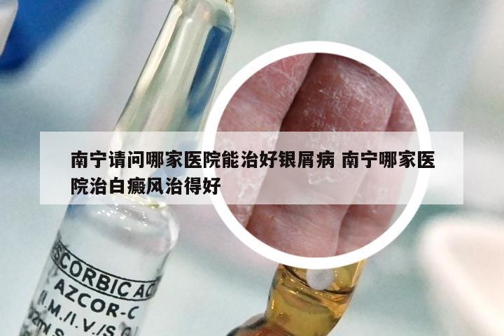 南宁请问哪家医院能治好银屑病 南宁哪家医院治白癜风治得好