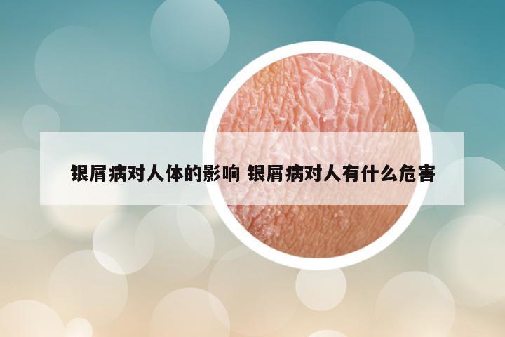 银屑病对人体的影响 银屑病对人有什么危害