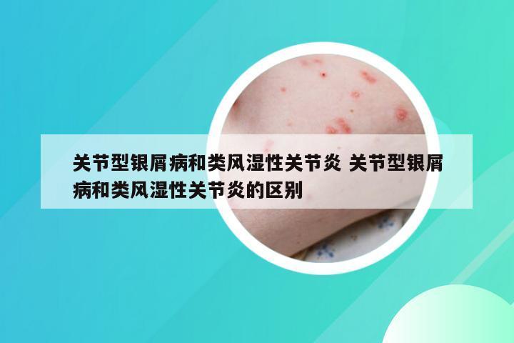 关节型银屑病和类风湿性关节炎 关节型银屑病和类风湿性关节炎的区别