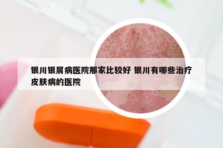银川银屑病医院那家比较好 银川有哪些治疗皮肤病的医院