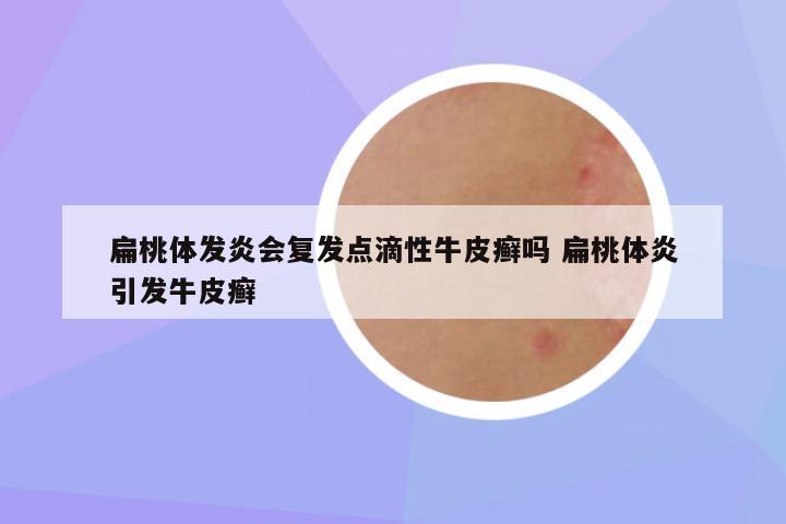 扁桃体发炎会复发点滴性牛皮癣吗 扁桃体炎引发牛皮癣