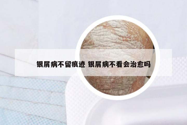银屑病不留痕迹 银屑病不看会治愈吗