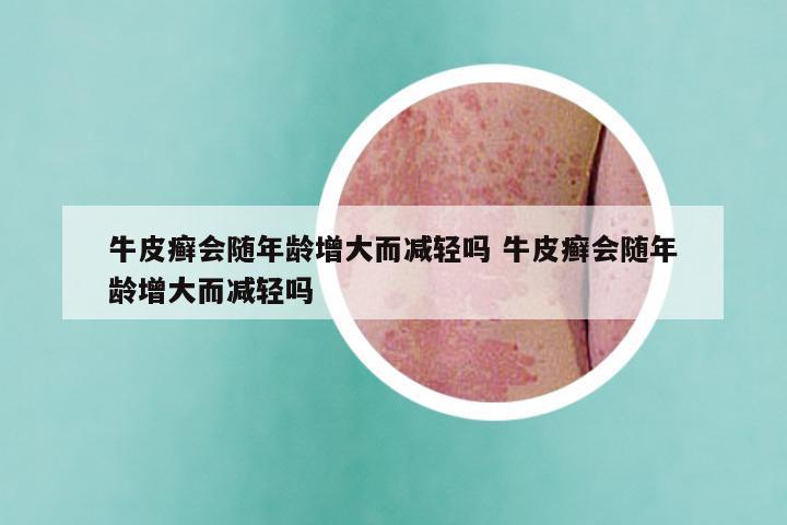 牛皮癣会随年龄增大而减轻吗 牛皮癣会随年龄增大而减轻吗