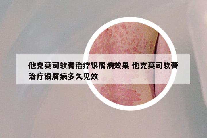 他克莫司软膏治疗银屑病效果 他克莫司软膏治疗银屑病多久见效