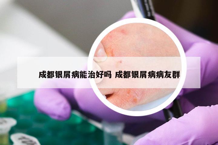 成都银屑病能治好吗 成都银屑病病友群