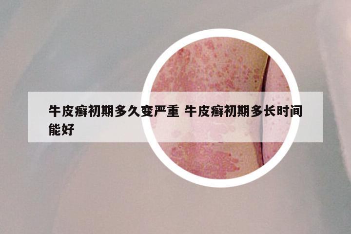 牛皮癣初期多久变严重 牛皮癣初期多长时间能好