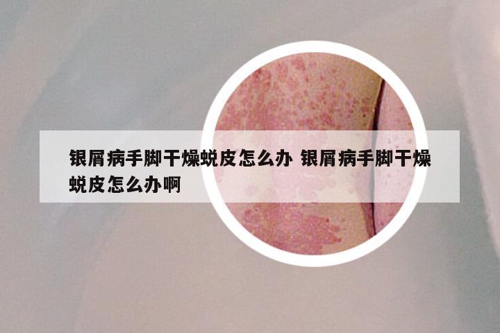 银屑病手脚干燥蜕皮怎么办 银屑病手脚干燥蜕皮怎么办啊