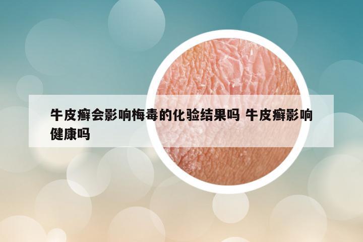 牛皮癣会影响梅毒的化验结果吗 牛皮癣影响健康吗