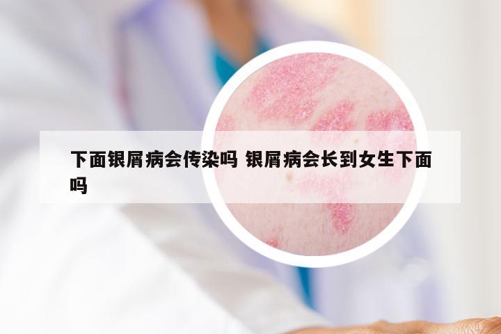 下面银屑病会传染吗 银屑病会长到女生下面吗